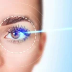 LASIK Eye Surgery: