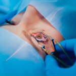 Laser Eye Surgery