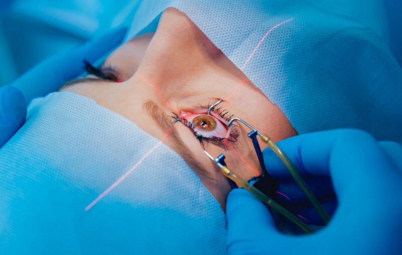 Laser Eye Surgery