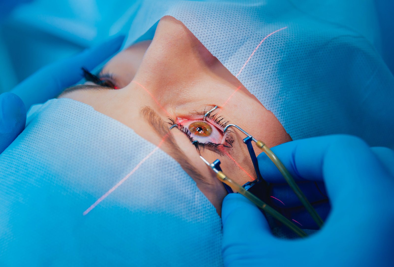 Laser Eye Surgery