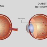 Diabetic Retinopathy