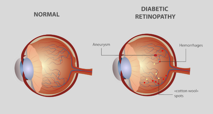 Diabetic Retinopathy